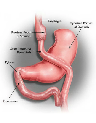 Gastric bypass