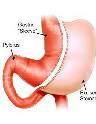 Sleeve gastrectomy